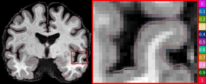 CSIRO researchers use machine learning to advance Alzheimer’s research CSIRO researchers use machine learning to advance Alzheimer’s research